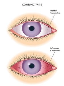 pink eye symptoms